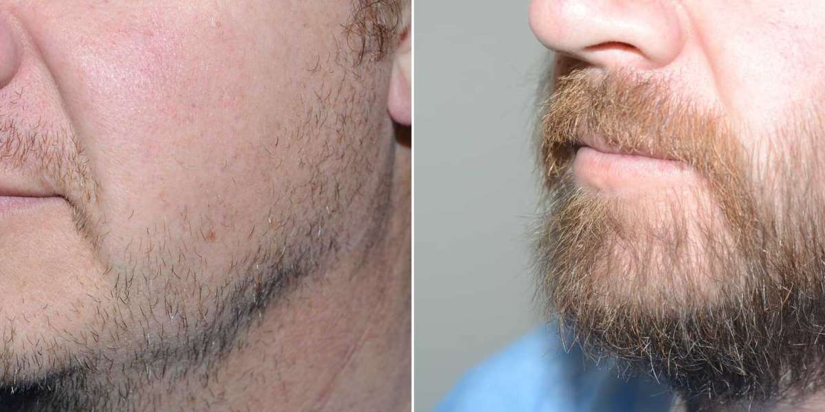 How Much Do Beard Transplants Cost