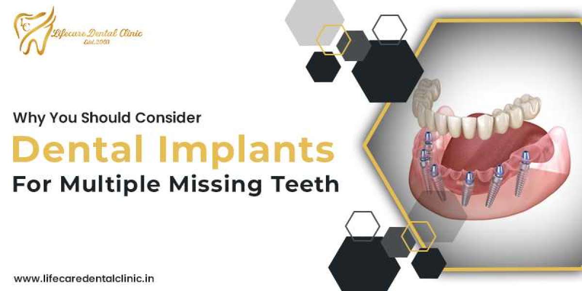 Dental Implants in Chandigarh | Dental Implantologist in Chandigarh